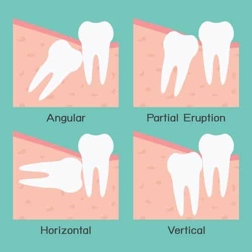 vector showing four examples of wisdom teeth: angular, partial eruption, horizontal, and vertical