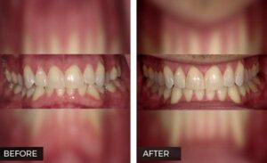 Invisalign before and after