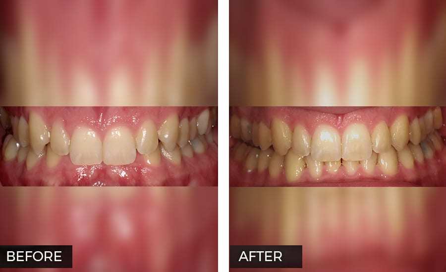 Invisalign before and after