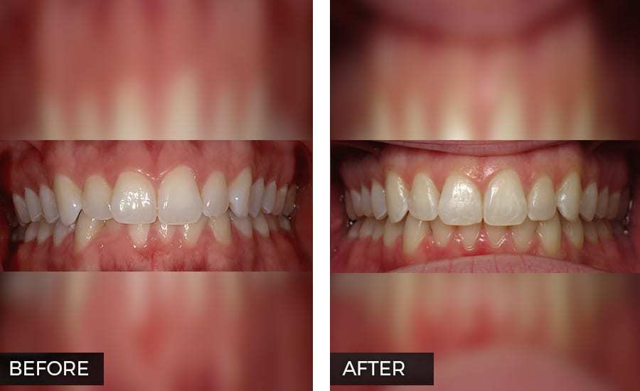 Invisalign before and after