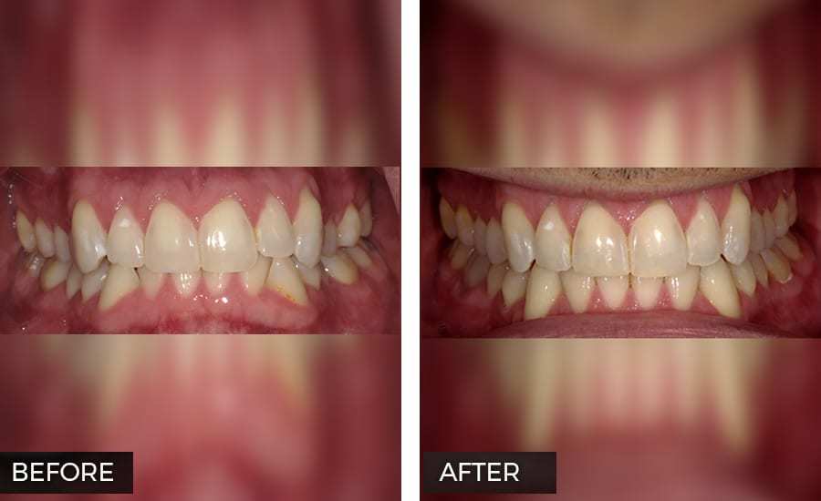 Invisalign before and after