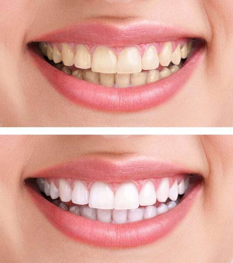 Before and after teeth whitening