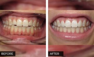 Teeth Bonding Before and After