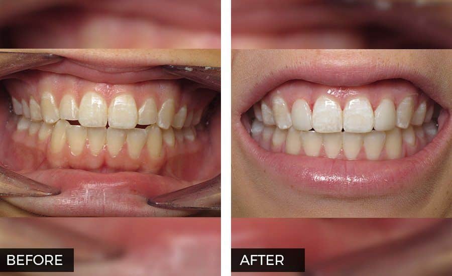 Dental Bonding - Before and After at Preventive Dentistry Braddon