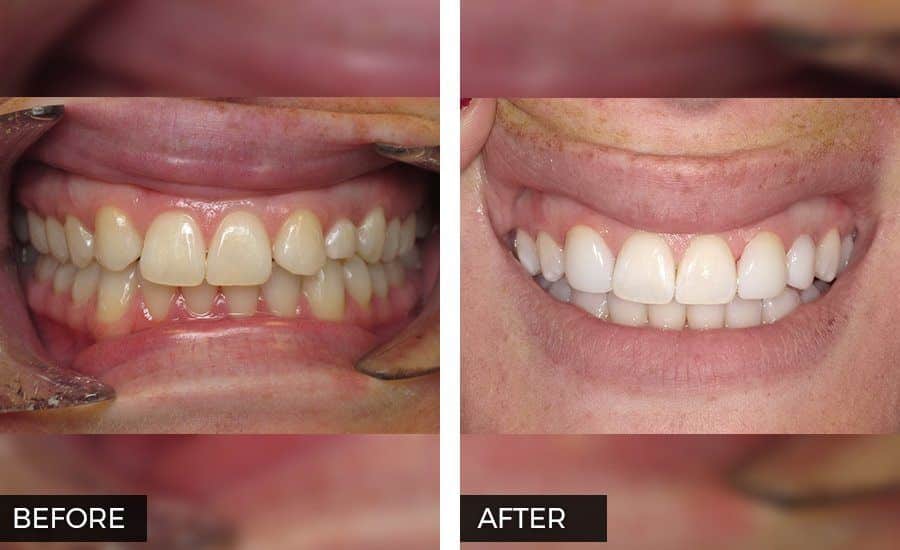 Teeth Bonding Before and After