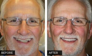 Denture Before and After