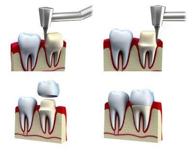 Dental Crown