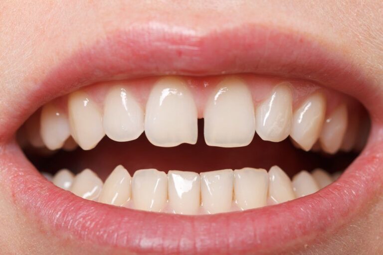 Diastema between the upper incisors, chipped front tooth