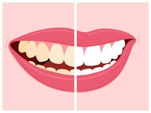 Before and after view of teeth whitening