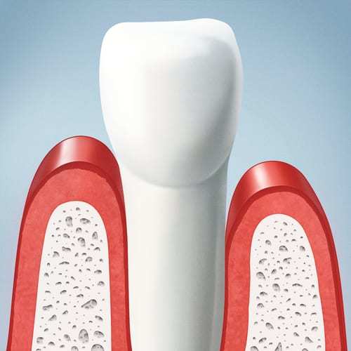 Illustration of a tooth with receding gums