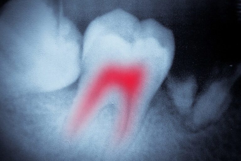 Dental tooth x-ray film