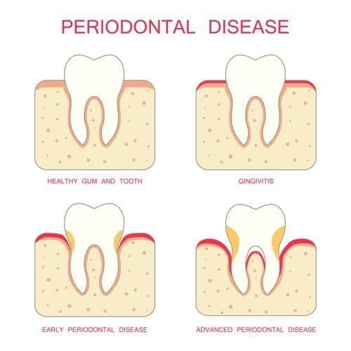 Periodontal Disease Treatment