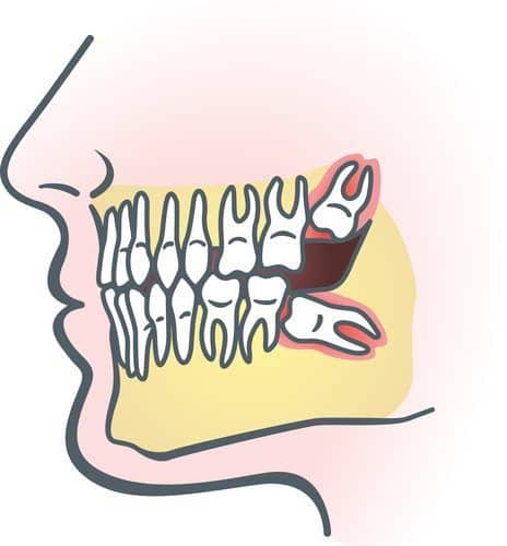 Wisdom Teeth Removal