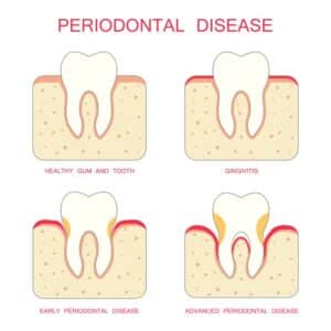 Illustration of the phases of periodontal disease
