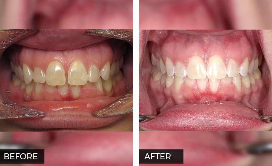 Invisalign before and after