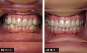 Invisalign before and after