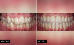 Invisalign Before and After