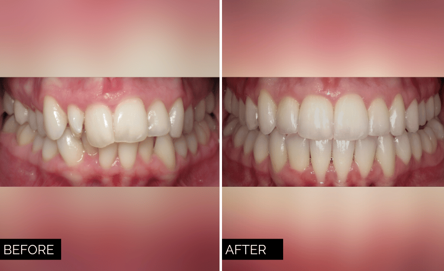 Invisalign Before and After