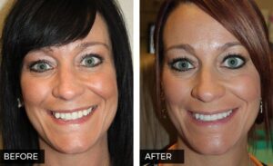 Invisalign Before and After