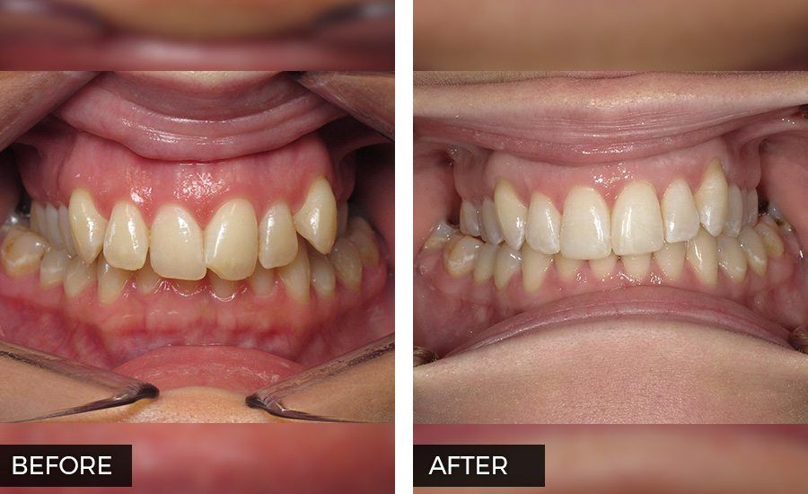 Invisalign before and after