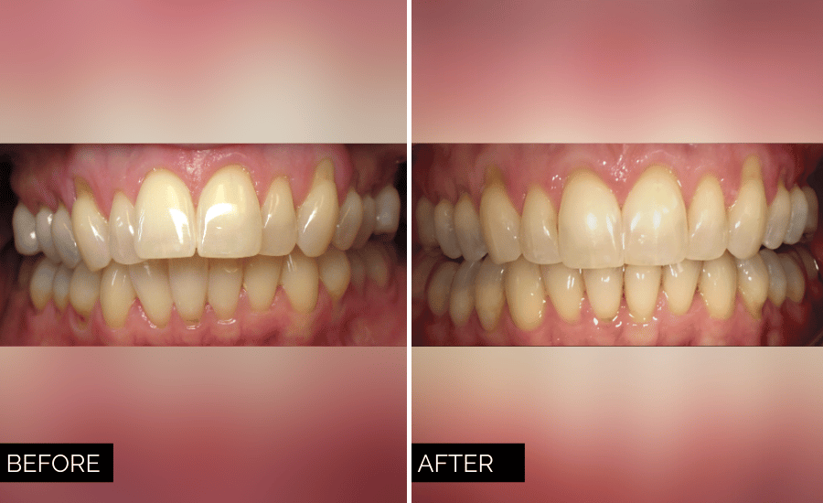 Invisalign Before and After