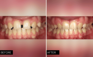 Invisalign Before and After