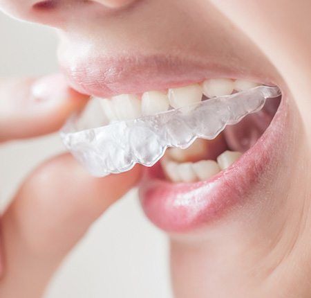 Invisalign