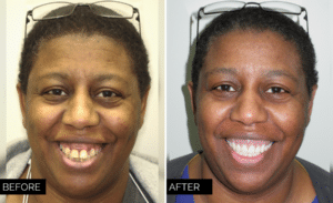 Dentures and Partials