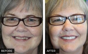 Smile Makeover