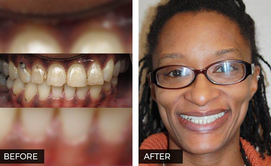 Smile Makeover