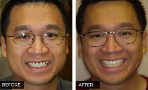 Before and After Smile Makeover