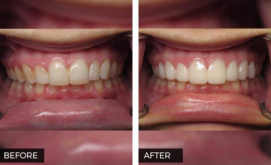 Veneers Before and After Photo