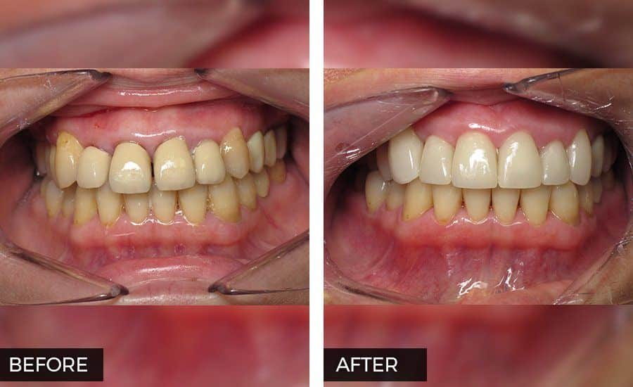 Veneers Before and After Photo