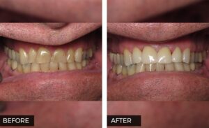 Crowns before and After Photo