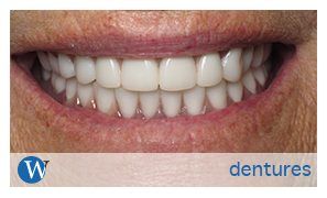 dentures_ferguson