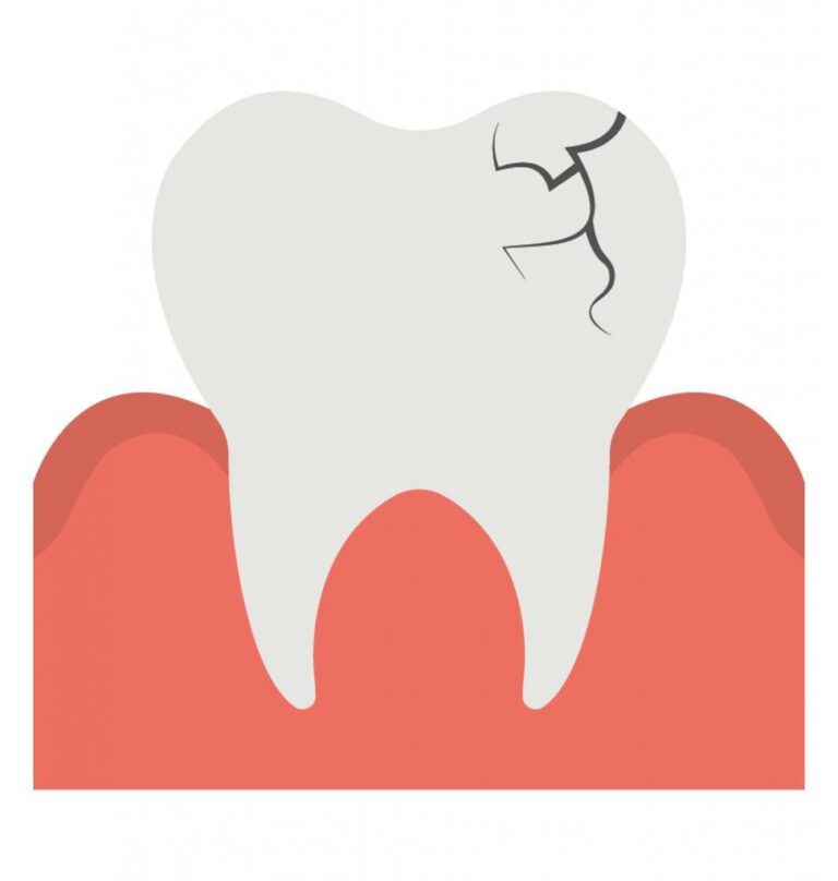 flat graphic of a cracked tooth in a gum