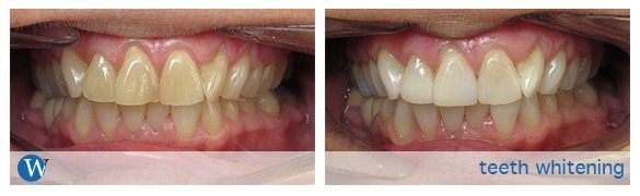 whitening