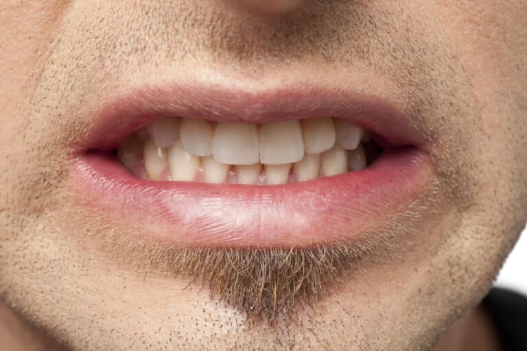 Close-up of man clenching or grinding his teeth