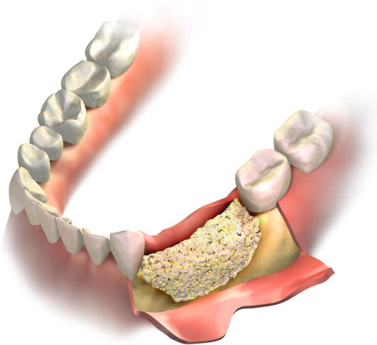 Graphic-of-bone-graft-placed-on-bone-loss-in-jaw-open-gum