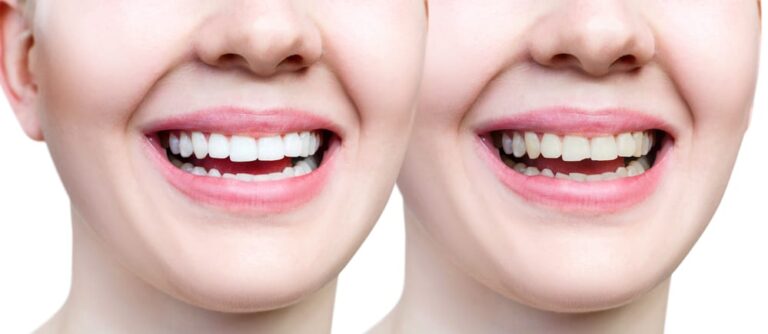 before-and-after-of-tooth-bonding-and-whitening