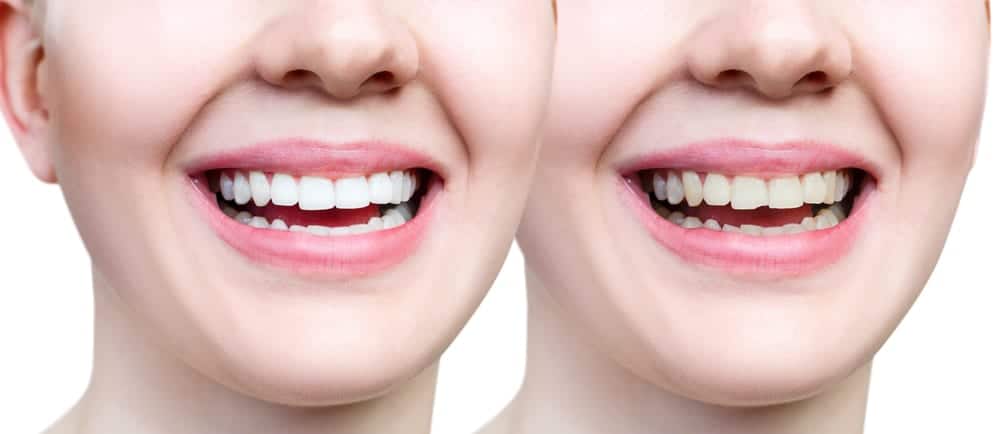 before and after of tooth bonding and whitening