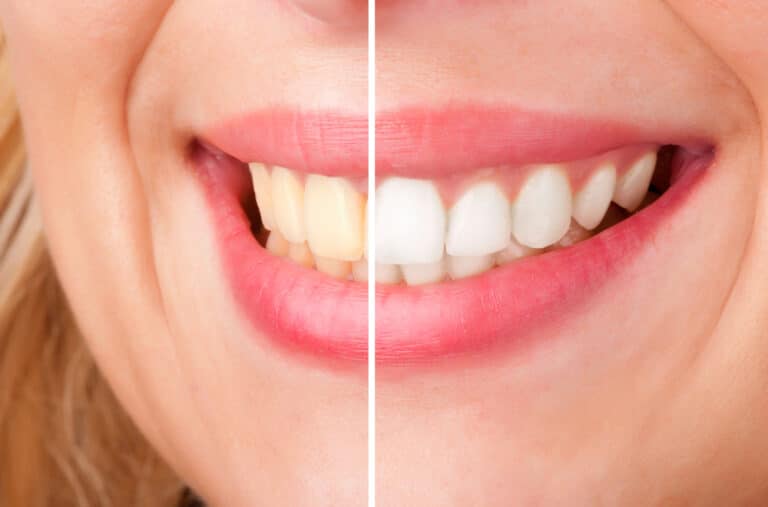 Close-up of woman smiling, left side yellow teeth, right side white teeth