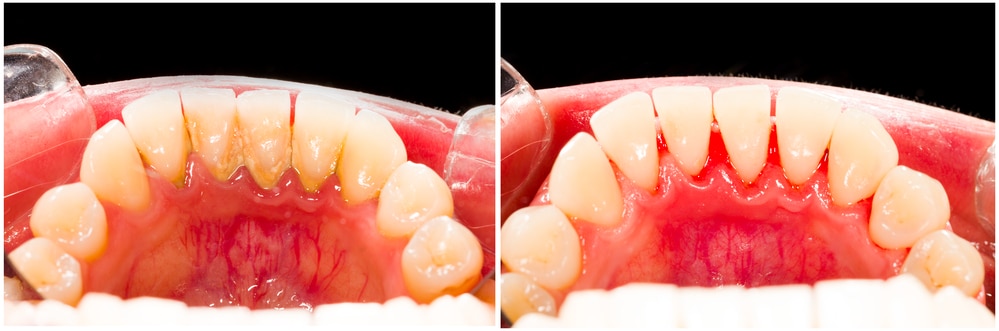 before and after photos of plaque removal