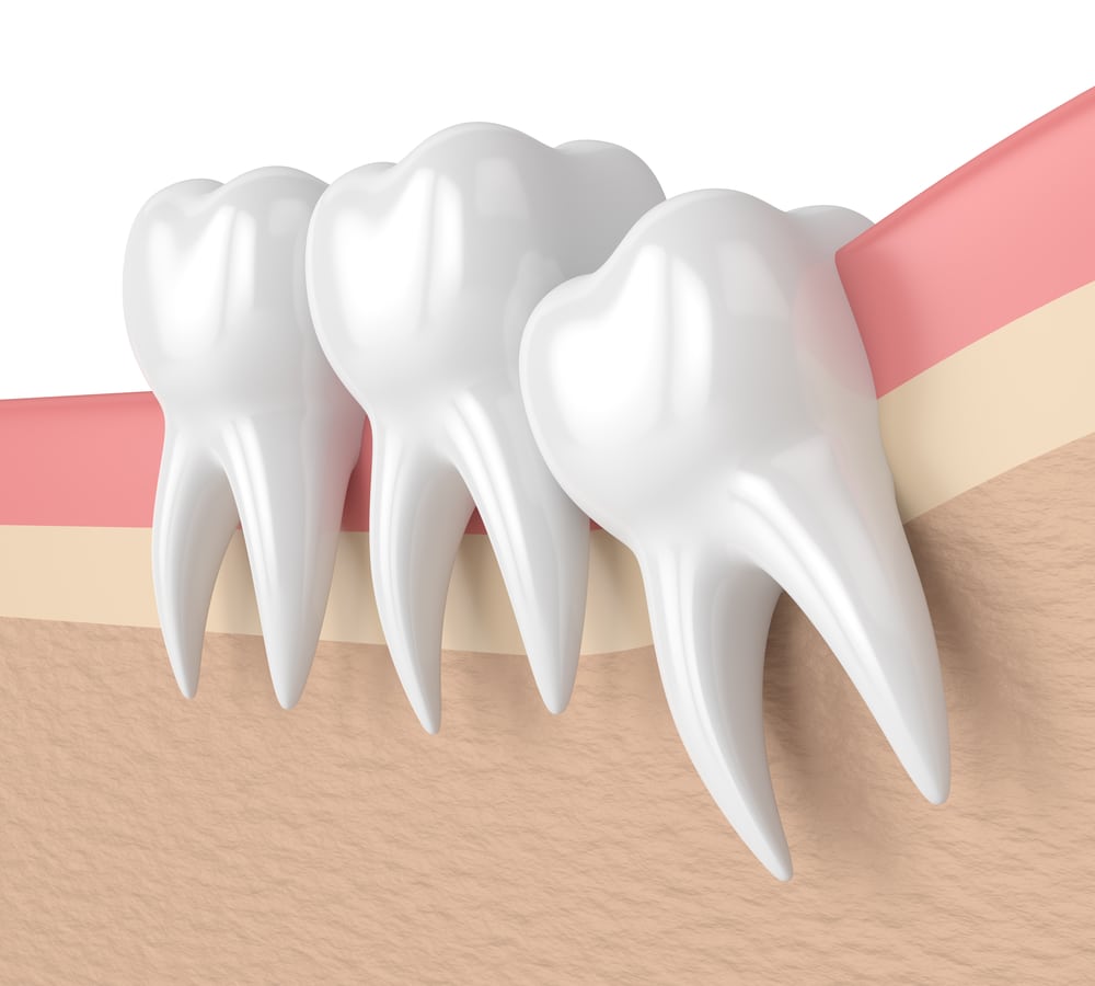 3d rendering of two molars and one wisdom tooth pushing against them