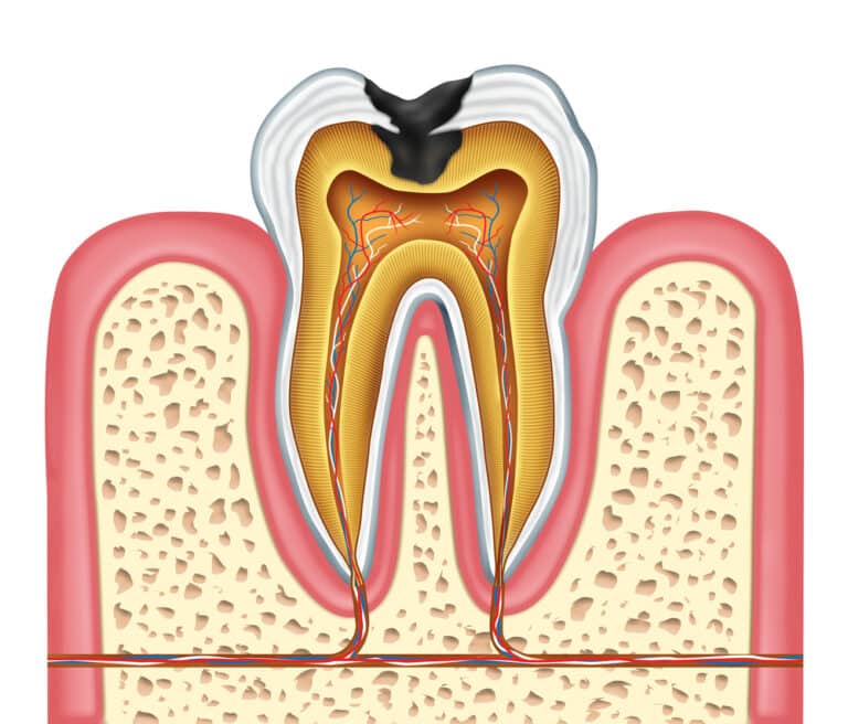Tooth inner anatomy, with cavity
