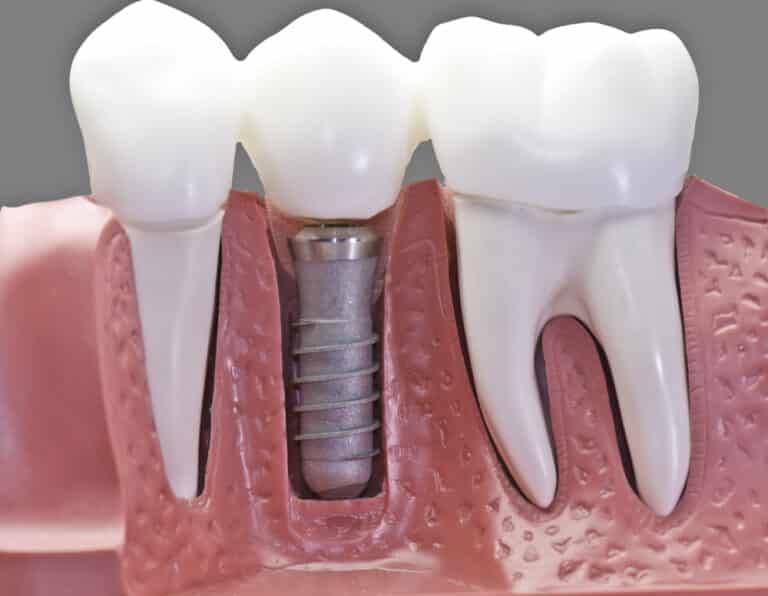 Model showing dental implant between natural teeth