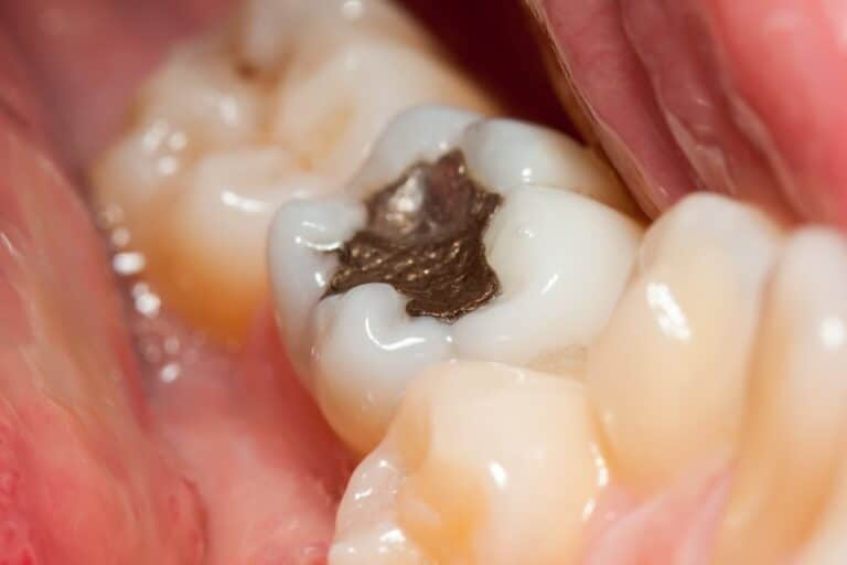 Close-up of amalgam filling