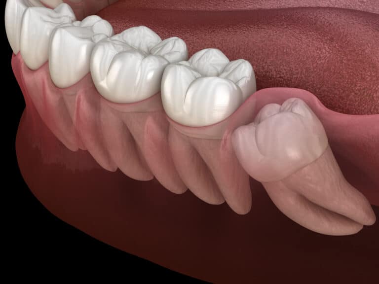 Graphic illustration of impacted wisdom tooth