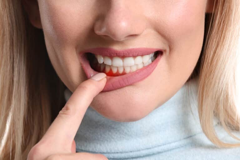 Close-up of young woman as she shows gum inflammation