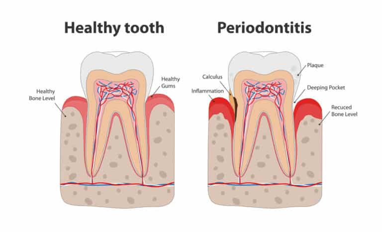 Graphic illustration of healthy tooth and tooth with periodontitis
